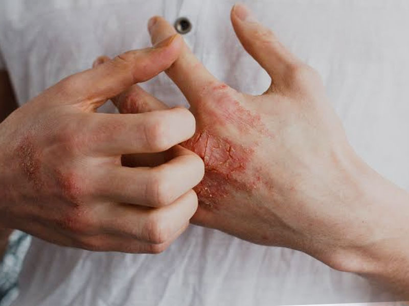 Here's Everything You Need To Know About Atopic Dermatitis By A  Dermatolgist - Here's Everything You Need To Know About Atopic Dermatitis  By A Dermatolgist