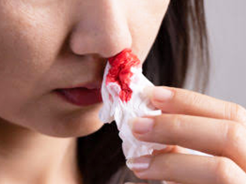 Epistaxis And Summer: Know The Risk Factors And Tips To Prevent And Manage Nosebleeding From An Expert 