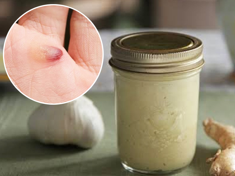 Want To Get Rid Of Blood Blisters On Your Skin? Here Are 7 Effective Home Remedies To Treat Them