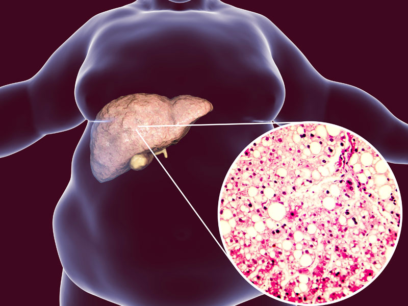 World Liver Day 2021: What Is Nonalcoholic Fatty Liver Syndrome? Know Symptoms, Causes, Treatment 