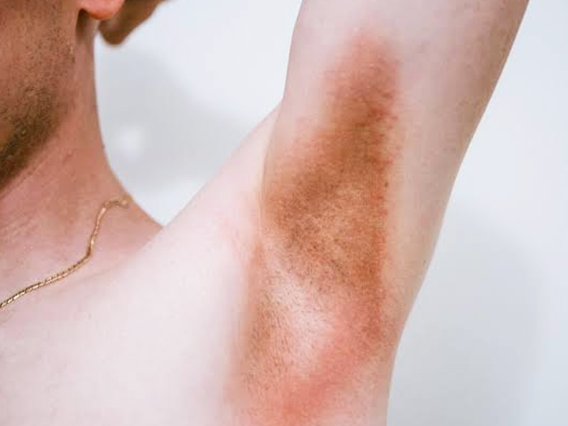 cutaneous candidiasis armpit