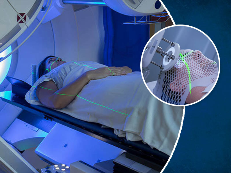 What Are The Side Effects Of Radiation Therapy? Know From An