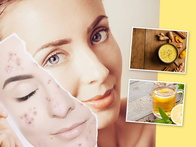 5 Effective Anti Acne Drinks To Include In Your Diet