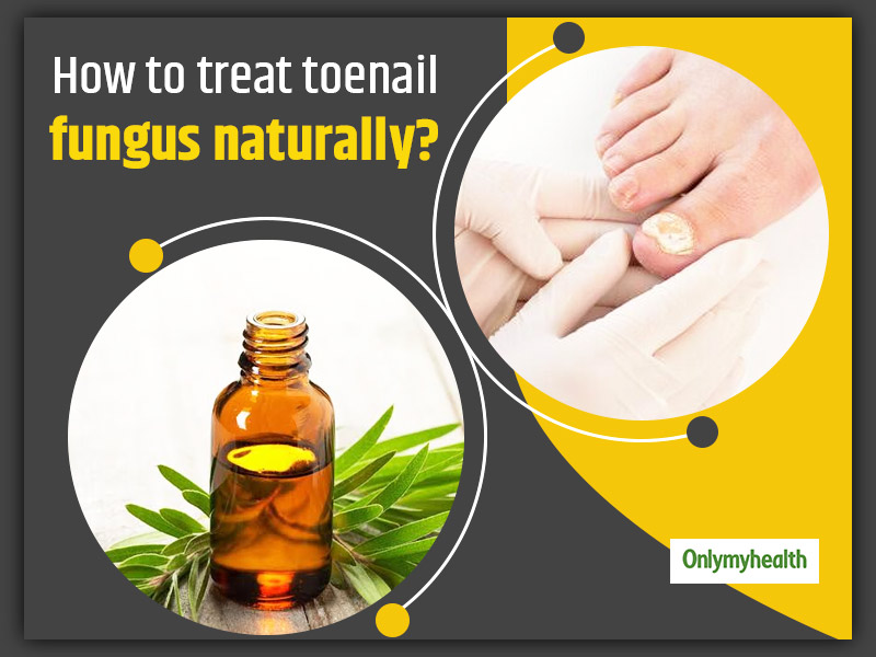 How to Treat Nail Fungus at Home: Top-10 Ways to Cure Toenail