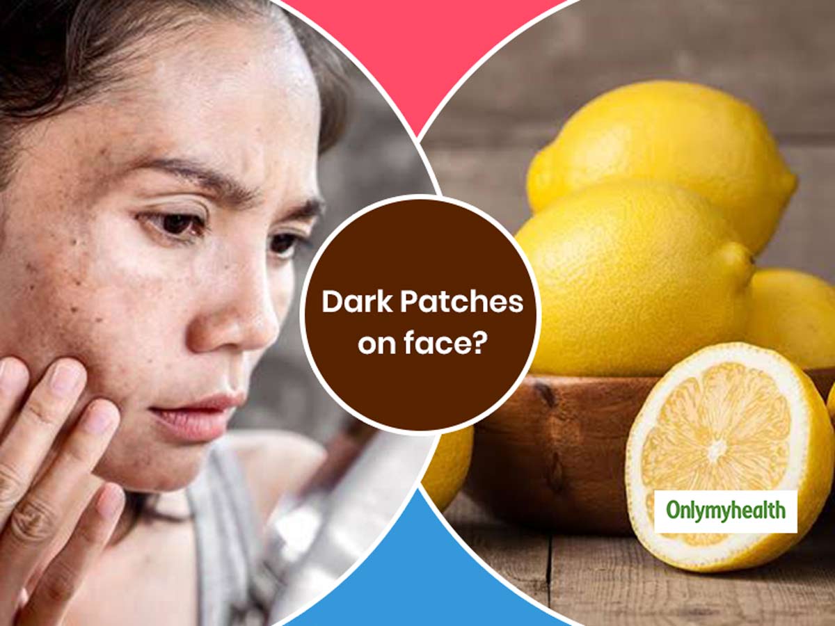 Dark Patches On Face Try These 5 Natural Remedies To Treat Them At Home dark patches on face try these 5