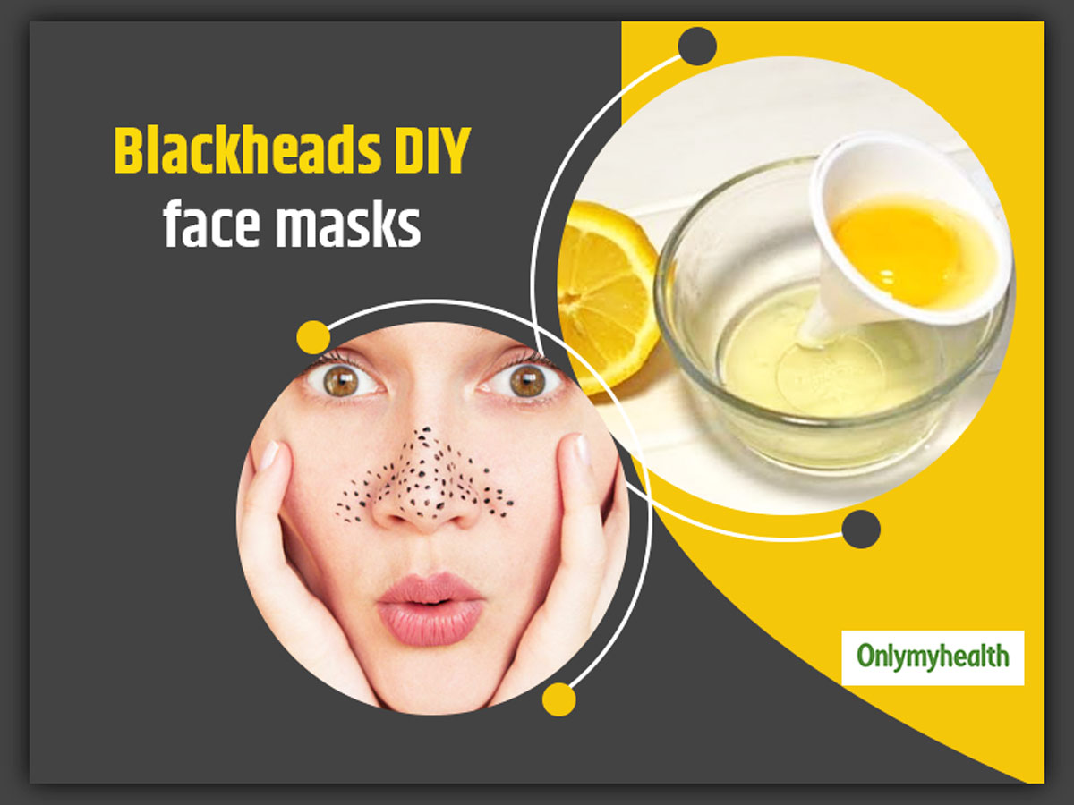 Tryk ned Selskab champignon Want To Get Rid Of Blackheads? Try These 6 Amazing DIY Face Masks To Remove  Those Skin Pores