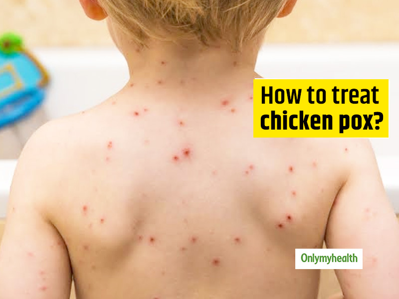 Chicken Pox: Causes, Symptoms, Complications, Treatment And