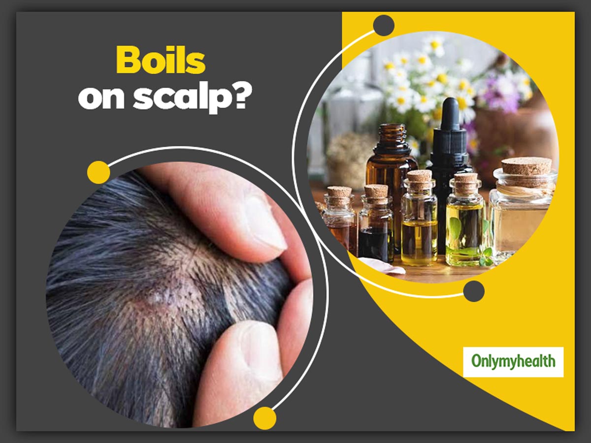 Boils On Scalp? Here Are 5 Useful Home Remedies To Get Rid Of Them