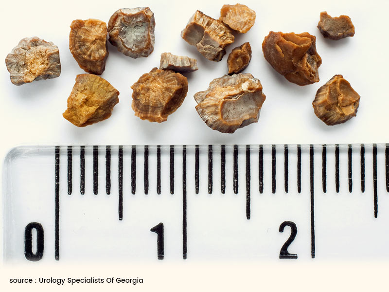 9 Kidney Stone Myths That You Should Not Fall For