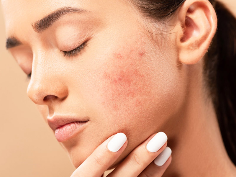 5 Things That Can Worsen Your Acne