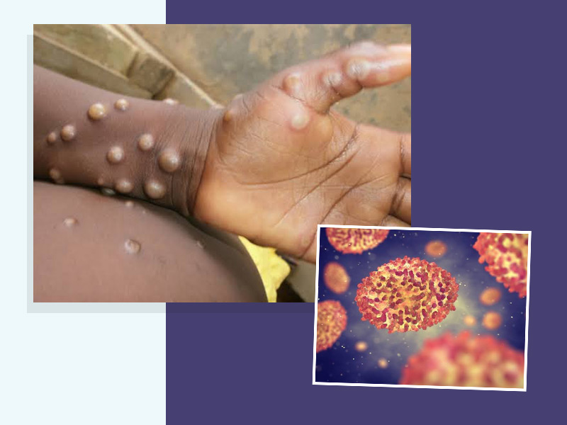 What Is Monkeypox: Symptoms, Pictures, and Treatment