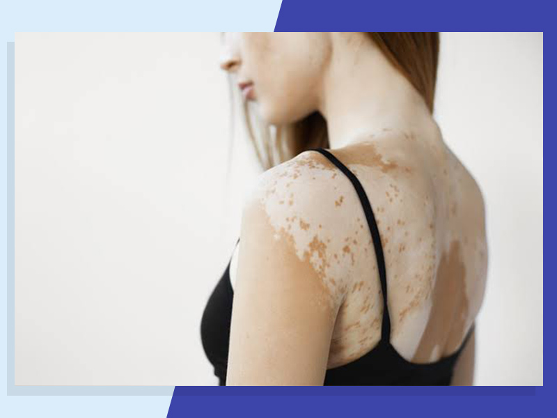 World Vitiligo Day 2021: Symptoms, Causes, Treatment For Vitiligo