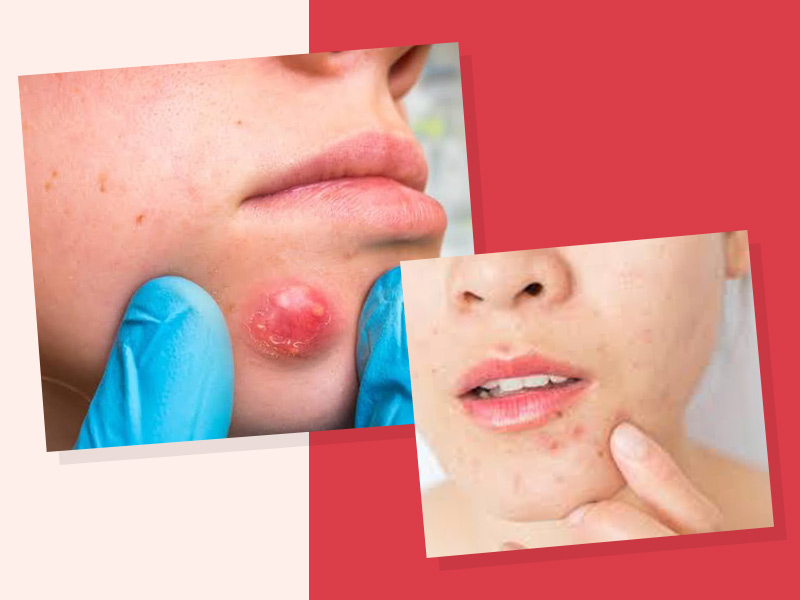 Is That A Boil Or A Pimple? Learn How To Identify Them