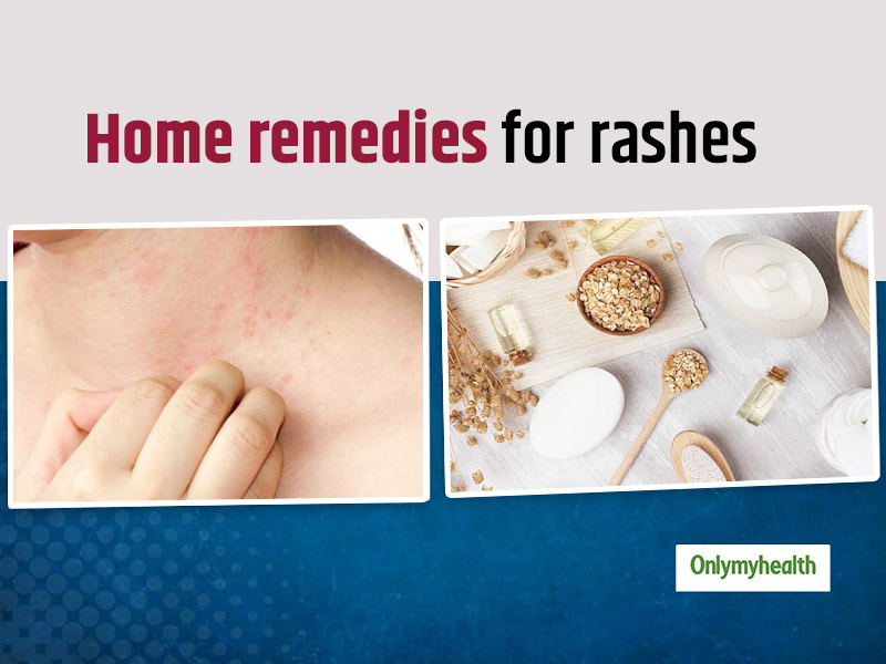 What are Welts (Skin Rash)? : Causes, Treatment, Home Remedies