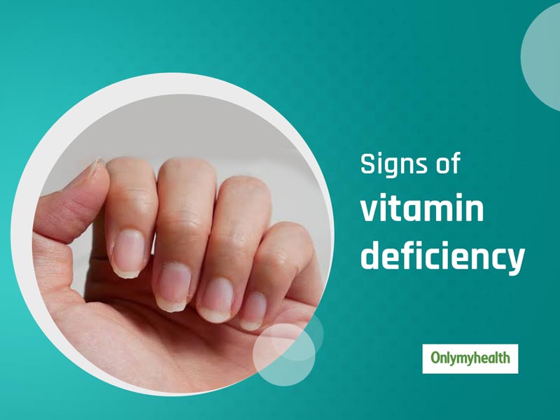 These 5 Signs Show That You Are Having A Vitamin Deficiency 