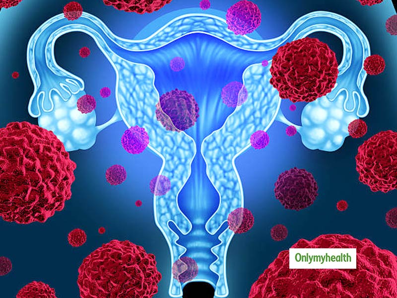 Stages of Cervical Cancer, Symptoms, Identification And Preventive Methods