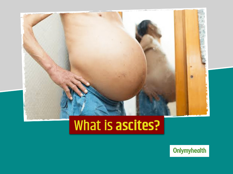 Do You Have Abdominal Swelling? Here Are The Symptoms, Causes, Diagnosis And Treatment Of Ascites