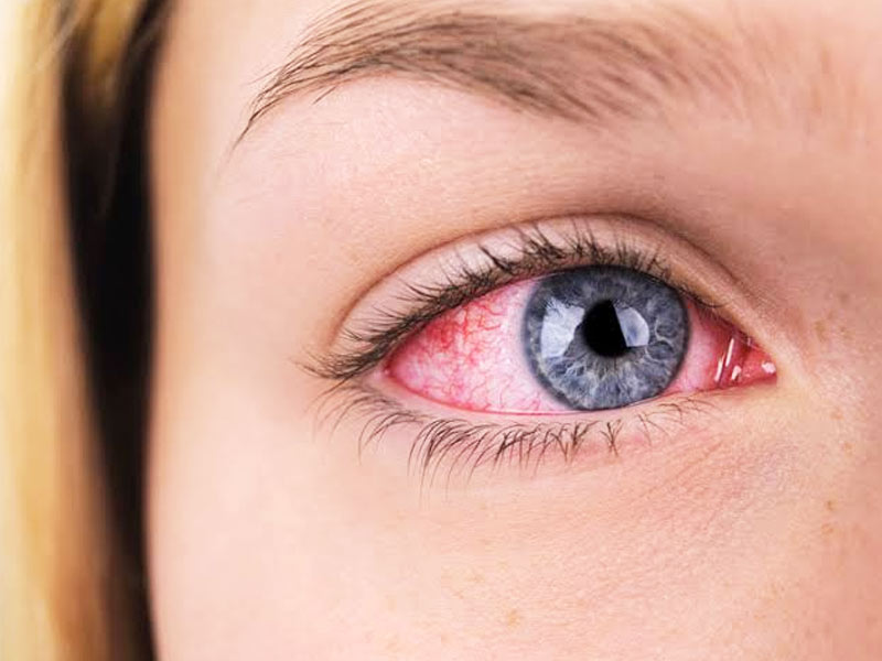 Have Eyelid Swelling? Know Everything About Blepharitis From An Opthalmologist