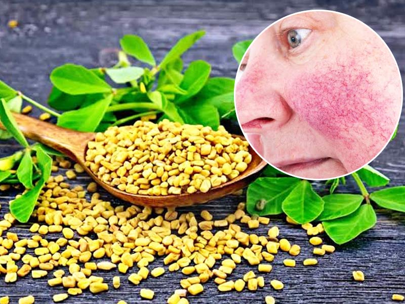 Chronic Redness On The Face? Here Are 7 Effective Natural Remedies For Rosacea 