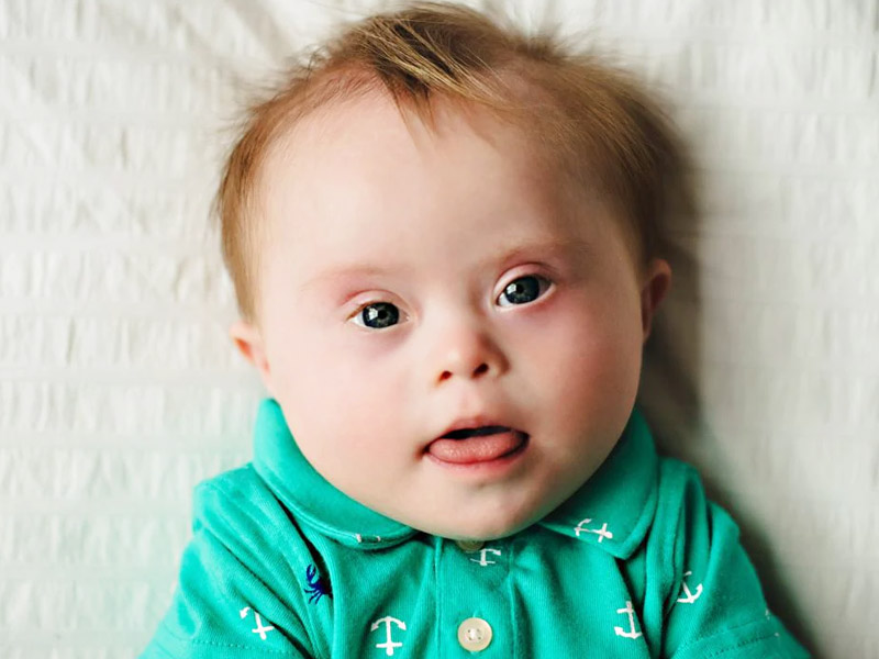What Is Down Syndrome, How Is It Detected And Care Tips 