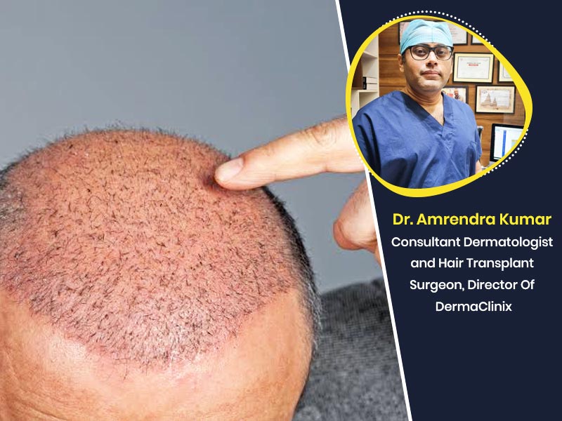 Expert Busts 6 Common Myths About Hair Transplantation