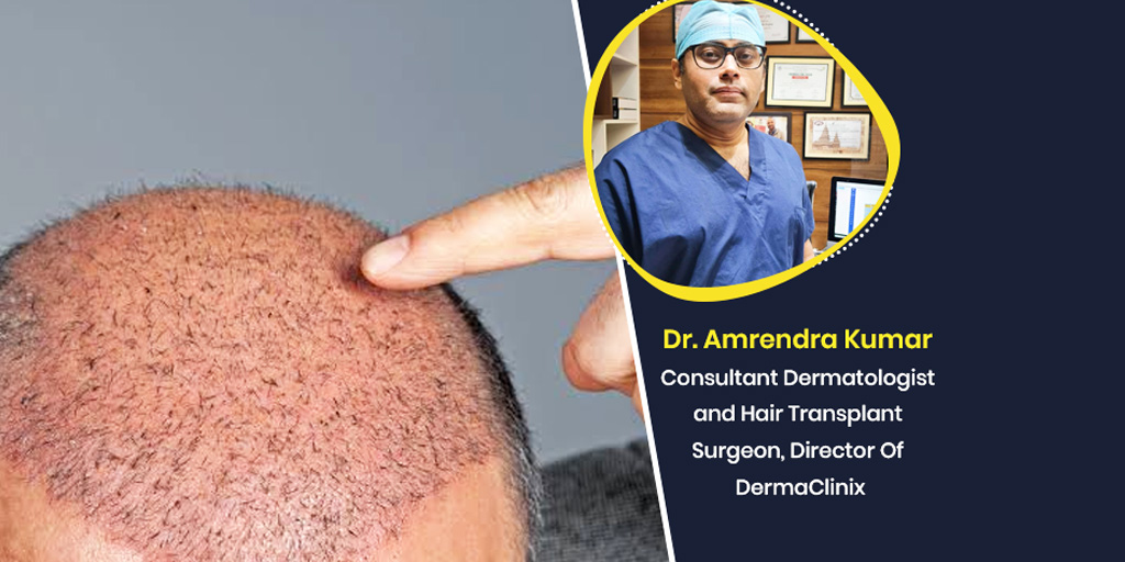 Expert Busts 6 Common Myths About Hair Transplantation