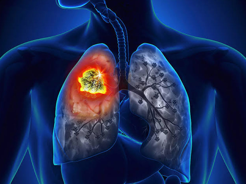 Recent Developments in Lung Cancer Management Explained By An Oncologist