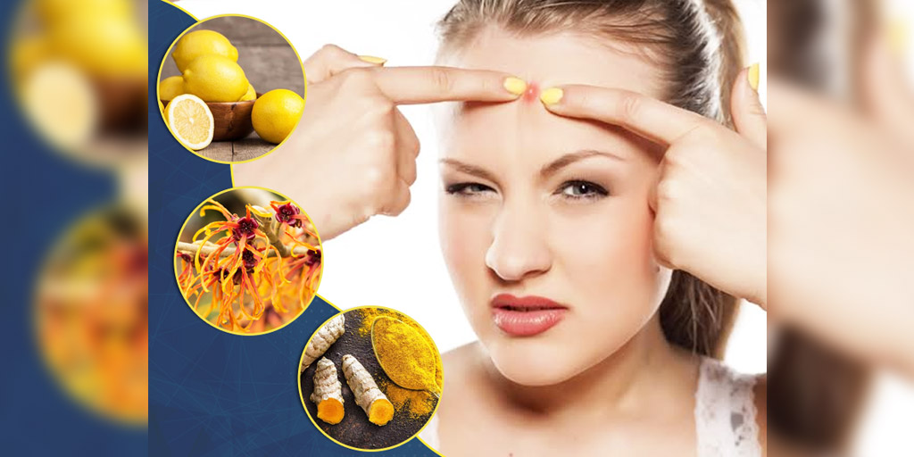 5 Effective Natural Remedies To Cure Sebaceous Cysts