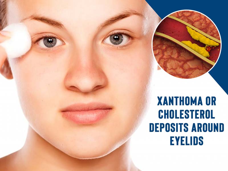 how do i remove cholesterol deposits under eyes