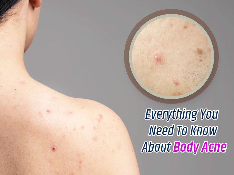 Struggling With Body Acne, Here Is All You Need To Know