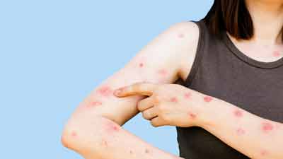 Expert Talk: How Monkeypox Effects Your Skin & Bod...