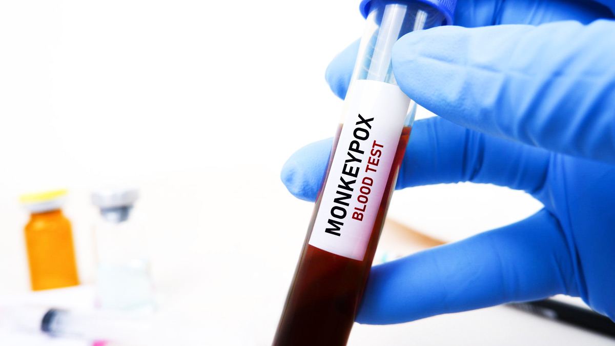Monkeypox: Antiviral Tecovirimat Found Safe And Effective For Treatment, Says Study