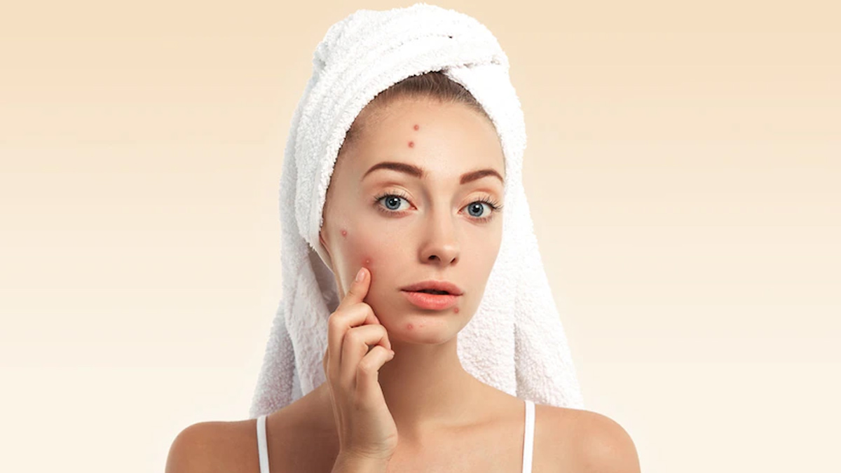 How Cholesterol And Acne Are Linked