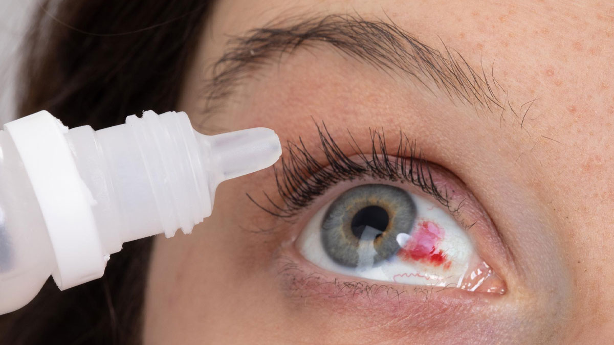 Eye Bleeding: Types, Causes, Symptoms & Treatment