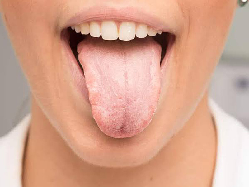 What Is Dry Mouth? Know The Symptoms, Causes, Treatment