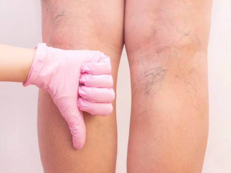  Expert Suggests Useful Tips To Manage Varicose Veins