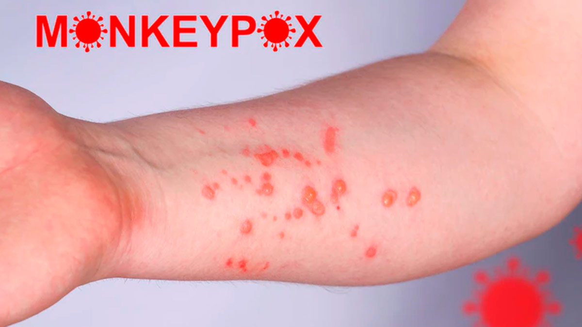  WHO Declares Monkeypox A Public Health Emergency