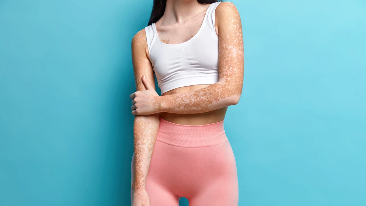 FDA Approves New Treatment For Vitiligo 
