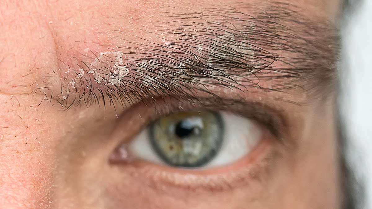 What Is Eyebrow Dandruff? Know Symptoms, Causes, Treatment 
