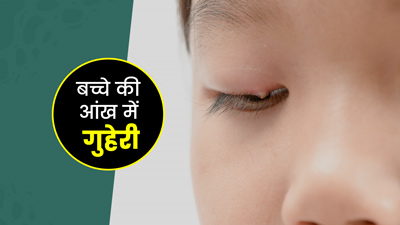बच्चे की आंख में गुहेरी (स्टाई) होने पर आजमाएं ये 3 घरेलू उपाय, जानें बचाव के टिप्स