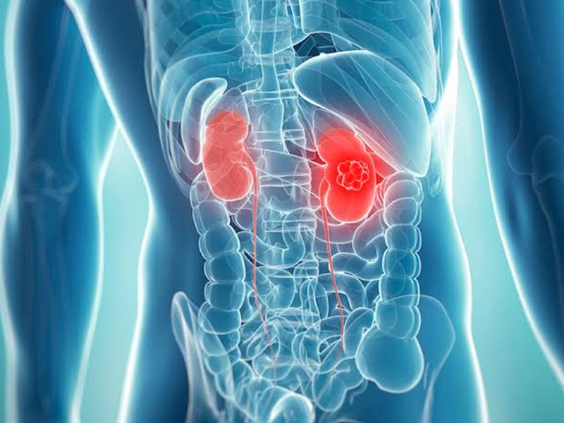 Obesity Can Put You At A Higher Risk Of Kidney Cancer, Know Other Factors From An Expert