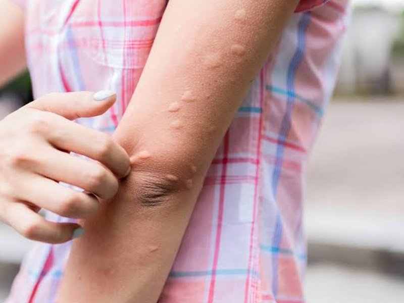  Mosquito Season Is Back, Try These 7 Home Remedies To Prevent Bites