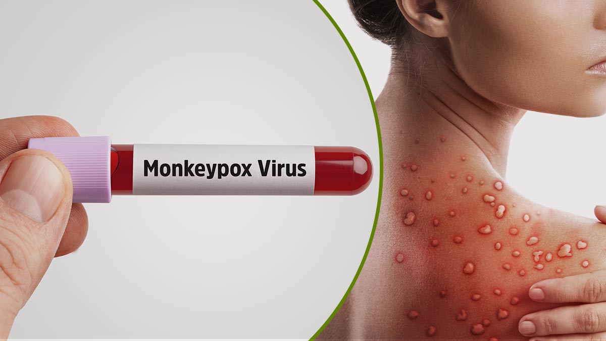 Monkeypox Does Not Spread By Air Like COVID-19: CDC; Here Is The Travel Precaution Advisory