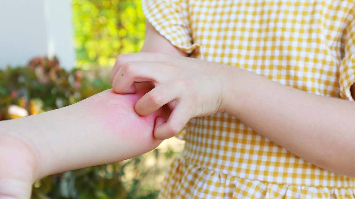 Follow These 7 Quick Home Remedies To Treat Seasonal Rashes