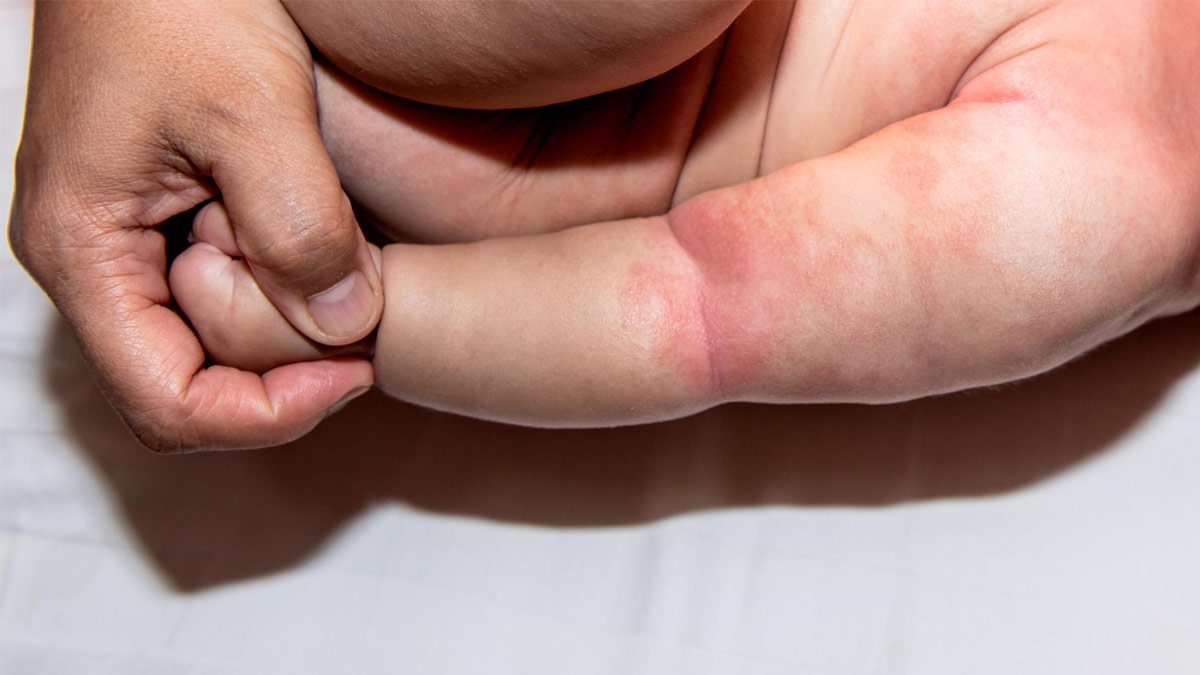 New Drug Reduces Symptoms Of Eczema By 75% In Infants And Children