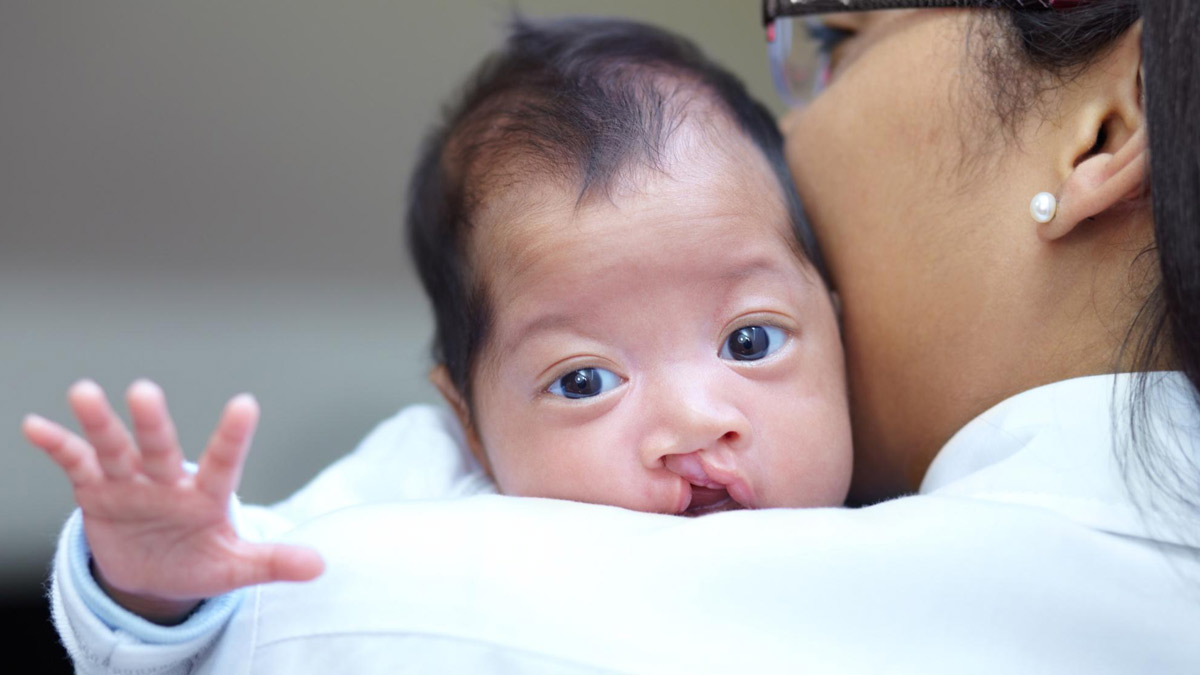 Cleft Lip & Palate: Everything You Need to Know About, As Per Expert