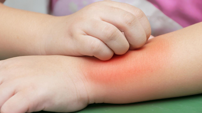 Highly Effective Drug Therapy For Young Children With Severe Eczema