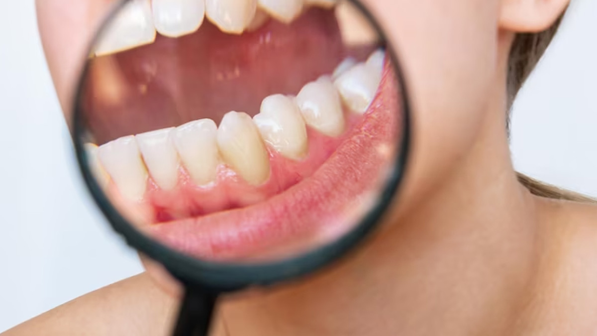7 Natural Home Remedies To Get Rid Of Tartar In Teeth
