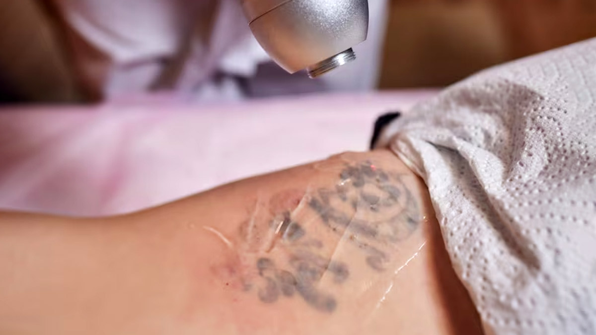 Stuck With A Permanent Tattoo? Here Are 4 Safe Ways To Get Rid Of It