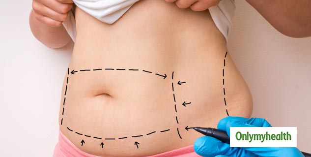 Debunking Common Liposuction Myths: Expert Reveals 5 Hidden Secrets 